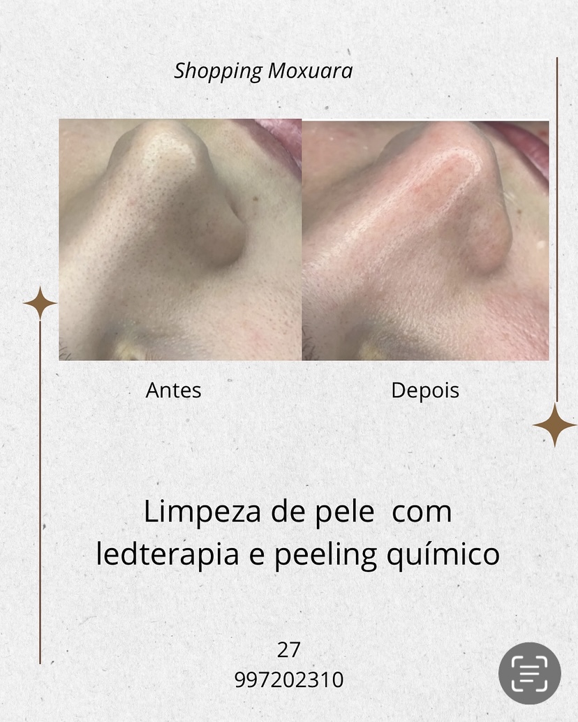 Limpeza de pele + peeling químico