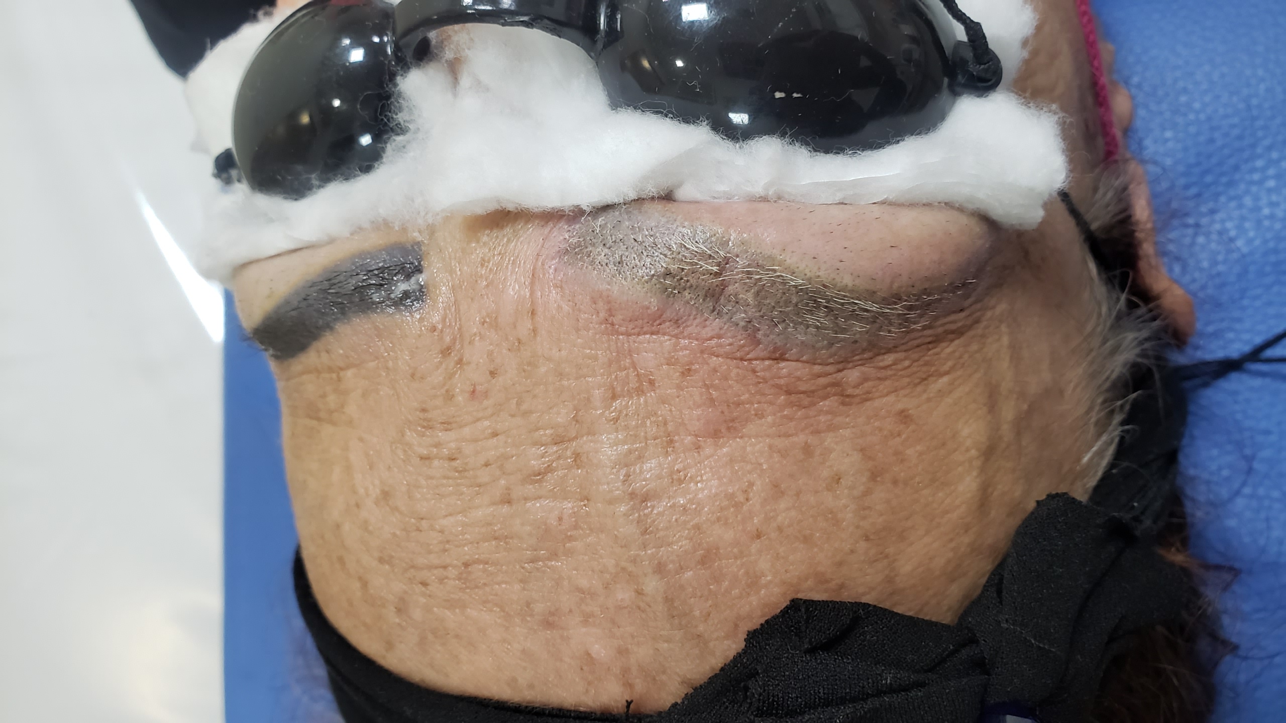 Sessão a laser de despigmentação de micropigmentação de sobrancelhas